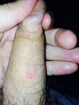 Latex Condom Allergic Reaction Penis Latex Condom Allergic Reaction Penis