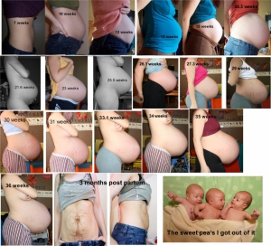 Pregnant With Triplets Belly Pregnant With Triplets Belly