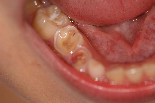 Acid Erosion Teeth Acid Erosion Teeth